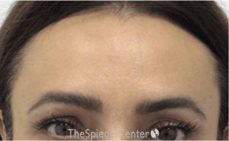 Browlift / Fox Eye Lift Before & After Gallery - Patient 245474 - Image 2