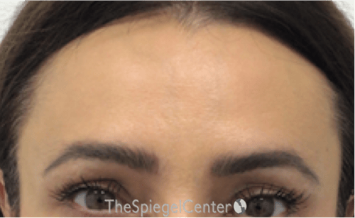 Brow Lift / Fox Eye Lift Before & After Gallery - Patient 245474 - Image 2