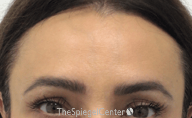 Brow Lift / Fox Eye Lift Before & After Gallery - Patient 245474 - Image 2