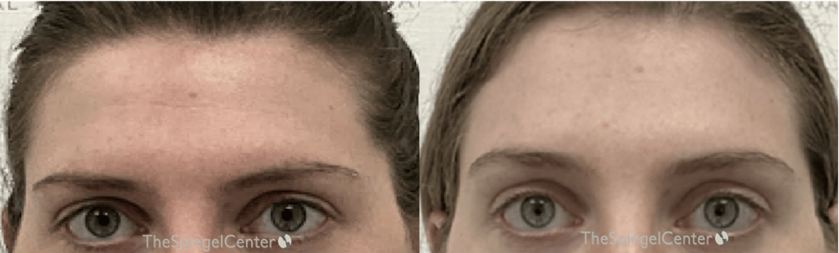 Browlift / Fox Eye Lift Before & After Gallery - Patient 296342 - Image 1