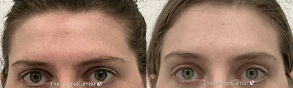 Brow Lift / Fox Eye Lift Before & After Gallery - Patient 296342 - Image 1
