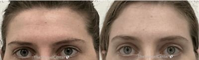 Browlift / Fox Eye Lift Before & After Gallery - Patient 296342 - Image 1