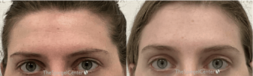 Brow Lift / Fox Eye Lift Before & After Gallery - Patient 296342 - Image 1
