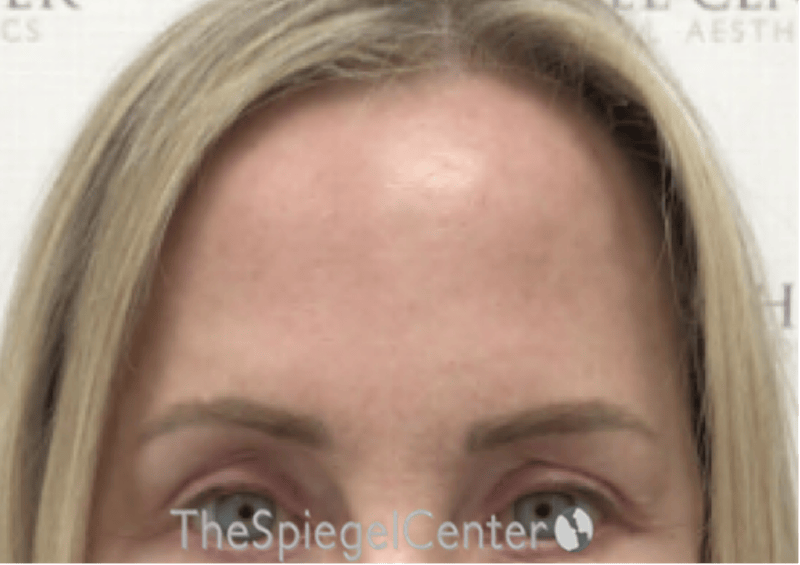 Browlift / Fox Eye Lift Before & After Gallery - Patient 144702 - Image 2