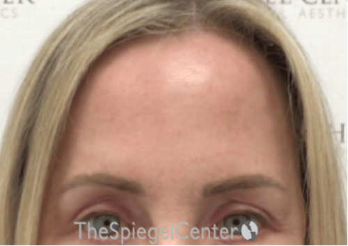 Brow Lift / Fox Eye Lift Before & After Gallery - Patient 144702 - Image 2