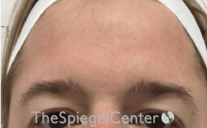 Brow Lift / Fox Eye Lift Before & After Gallery - Patient 274633 - Image 1