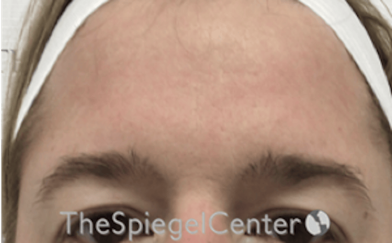 Browlift / Fox Eye Lift Before & After Gallery - Patient 274633 - Image 1
