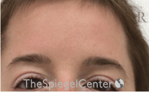 Brow Lift / Fox Eye Lift Before & After Gallery - Patient 274633 - Image 2