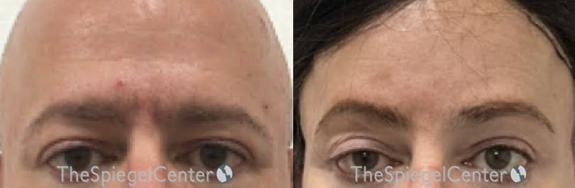 Brow Lift / Fox Eye Lift Before & After Gallery - Patient 190393 - Image 1
