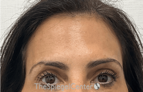 Brow Lift / Fox Eye Lift Before & After Gallery - Patient 424595 - Image 1