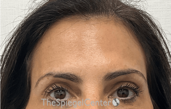 Brow Lift / Fox Eye Lift Before & After Gallery - Patient 424595 - Image 1