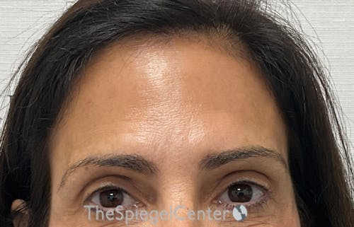 Brow Lift / Fox Eye Lift Before & After Gallery - Patient 424595 - Image 2