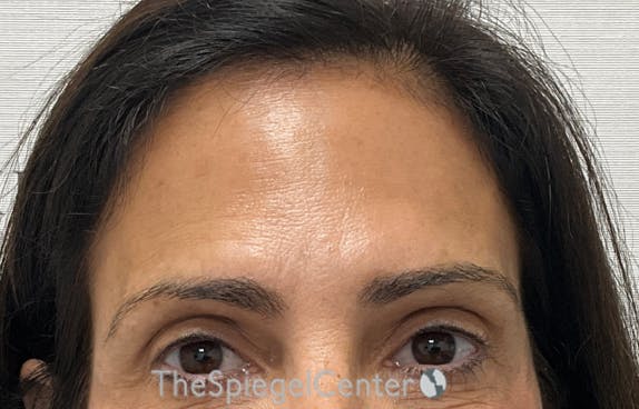 Brow Lift / Fox Eye Lift Before & After Gallery - Patient 424595 - Image 2
