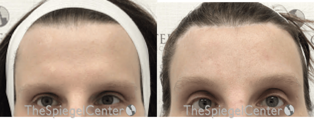 Browlift / Fox Eye Lift Before & After Gallery - Patient 694753 - Image 1