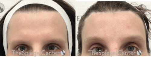 Brow Lift / Fox Eye Lift Before & After Gallery - Patient 694753 - Image 1