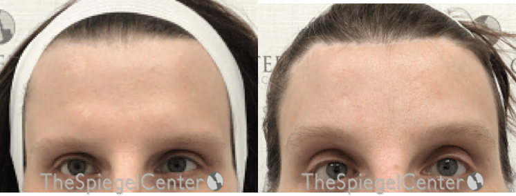 Brow Lift / Fox Eye Lift Before & After Gallery - Patient 694753 - Image 1