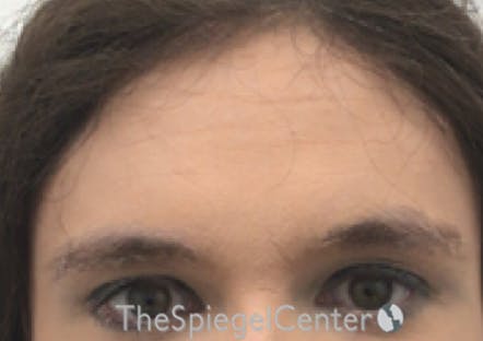 Brow Lift / Fox Eye Lift Before & After Gallery - Patient 387669 - Image 1