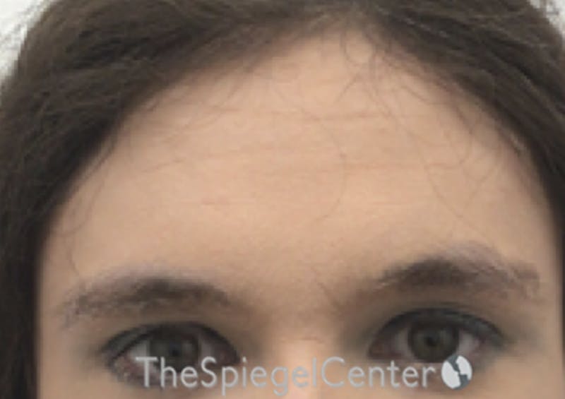 Browlift / Fox Eye Lift Before & After Gallery - Patient 387669 - Image 1