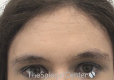 Browlift / Fox Eye Lift Before & After Gallery - Patient 387669 - Image 1