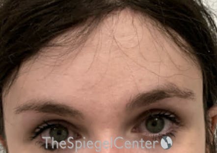 Brow Lift / Fox Eye Lift Before & After Gallery - Patient 387669 - Image 2