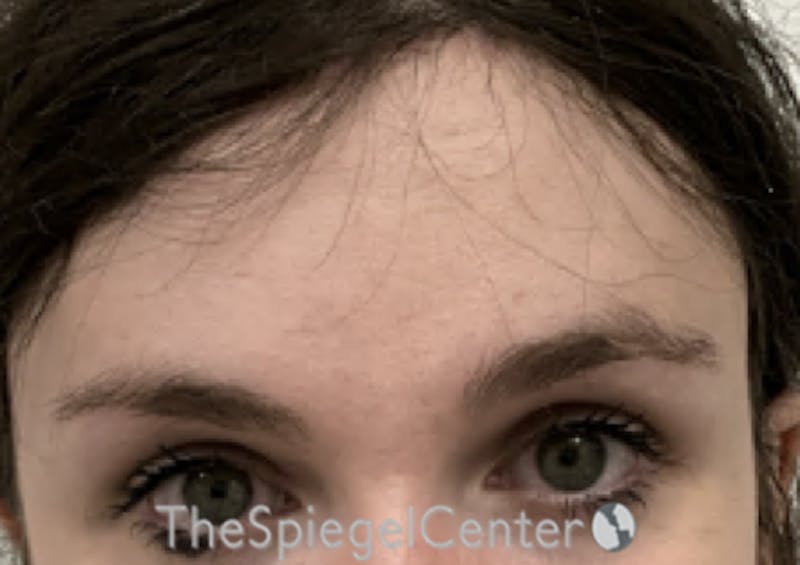 Browlift / Fox Eye Lift Before & After Gallery - Patient 387669 - Image 2
