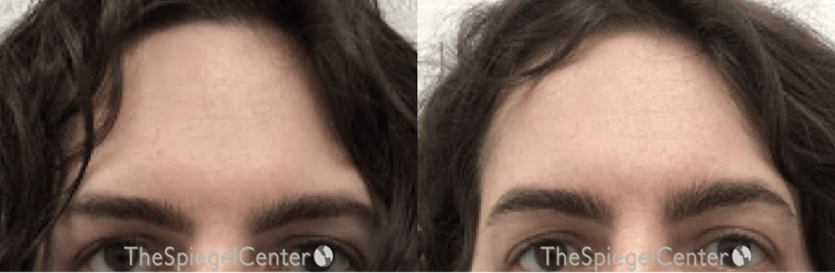 Browlift / Fox Eye Lift Before & After Gallery - Patient 240380 - Image 1
