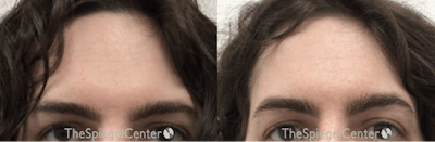 Browlift / Fox Eye Lift Before & After Gallery - Patient 240380 - Image 1