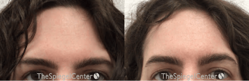 Brow Lift / Fox Eye Lift Before & After Gallery - Patient 240380 - Image 1