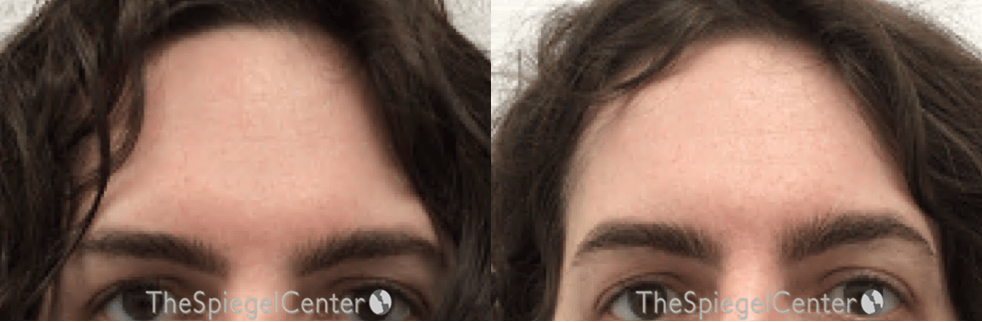 Brow Lift / Fox Eye Lift Before & After Gallery - Patient 240380 - Image 1