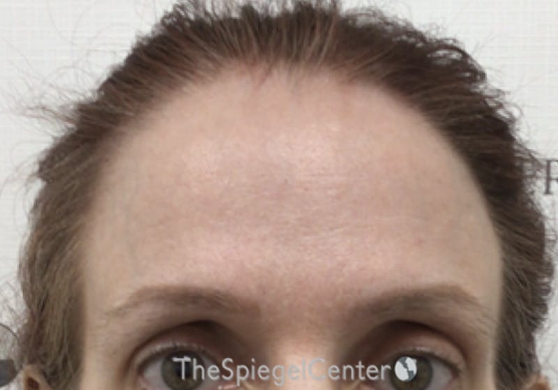 Browlift / Fox Eye Lift Before & After Gallery - Patient 355938 - Image 1
