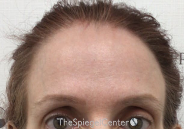 Brow Lift / Fox Eye Lift Before & After Gallery - Patient 355938 - Image 1