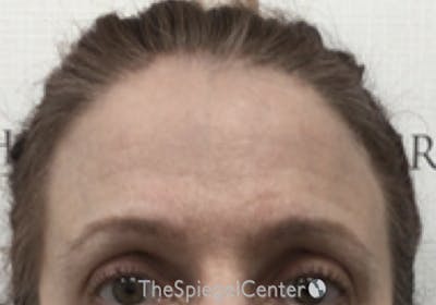 Browlift / Fox Eye Lift Before & After Gallery - Patient 355938 - Image 2