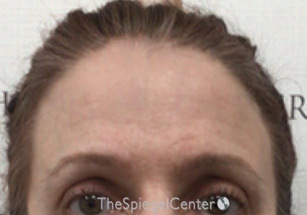 Brow Lift / Fox Eye Lift Before & After Gallery - Patient 355938 - Image 2