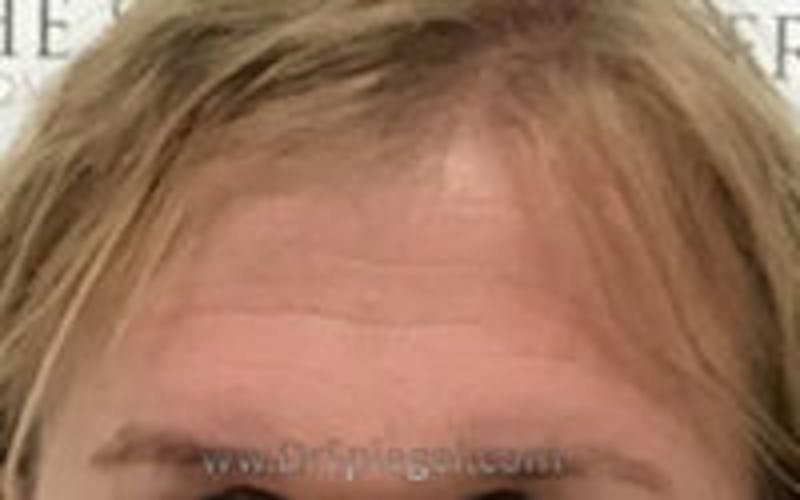 Browlift / Fox Eye Lift Before & After Gallery - Patient 343604 - Image 1