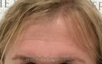 Brow Lift / Fox Eye Lift Before & After Gallery - Patient 343604 - Image 1