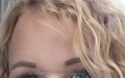 Browlift / Fox Eye Lift Before & After Gallery - Patient 343604 - Image 2