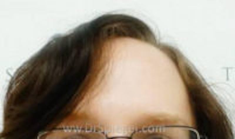 Browlift / Fox Eye Lift Before & After Gallery - Patient 237373 - Image 1