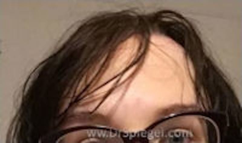 Browlift / Fox Eye Lift Before & After Gallery - Patient 237373 - Image 2