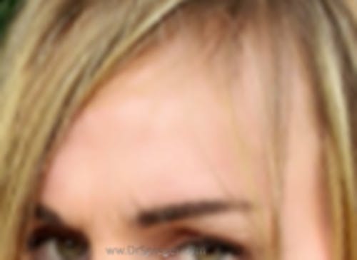 Brow Lift / Fox Eye Lift Before & After Gallery - Patient 353138 - Image 1