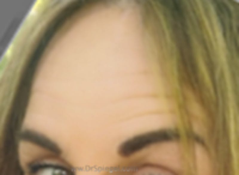 Browlift / Fox Eye Lift Before & After Gallery - Patient 353138 - Image 2