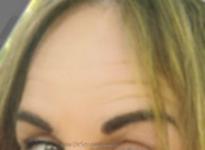 Browlift / Fox Eye Lift Before & After Gallery - Patient 353138 - Image 2