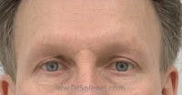 Brow Lift / Fox Eye Lift Before & After Gallery - Patient 298520 - Image 1