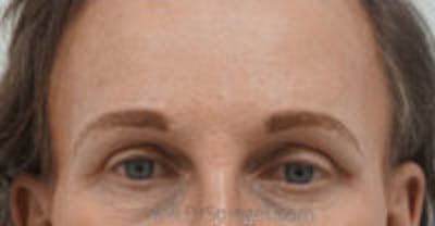 Browlift / Fox Eye Lift Before & After Gallery - Patient 298520 - Image 2