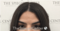 Brow Lift / Fox Eye Lift Before & After Gallery - Patient 152686 - Image 1