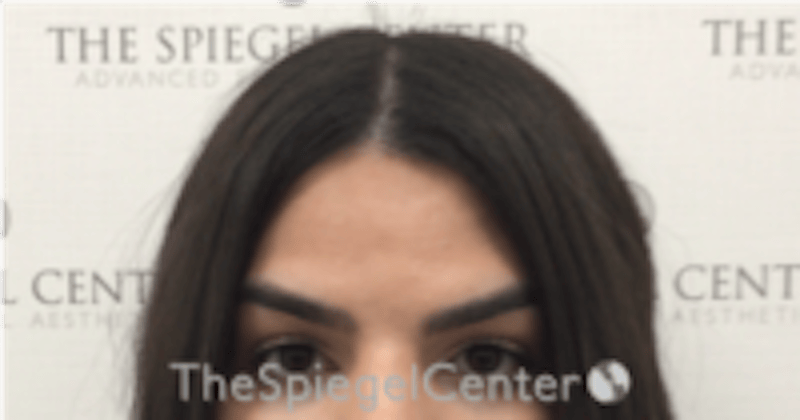 Browlift / Fox Eye Lift Before & After Gallery - Patient 152686 - Image 1