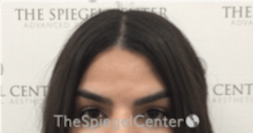 Brow Lift / Fox Eye Lift Before & After Gallery - Patient 152686 - Image 1