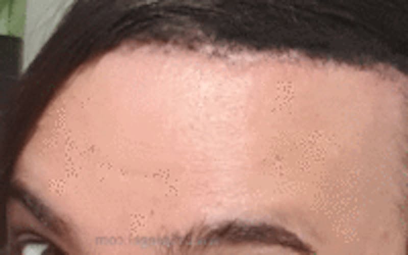 Browlift / Fox Eye Lift Before & After Gallery - Patient 392898 - Image 2