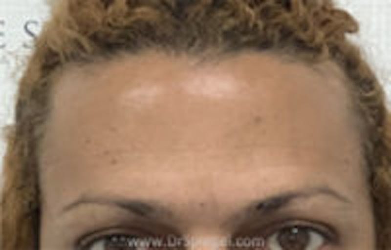 Browlift / Fox Eye Lift Before & After Gallery - Patient 308291 - Image 1