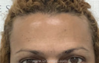 Browlift / Fox Eye Lift Before & After Gallery - Patient 308291 - Image 1
