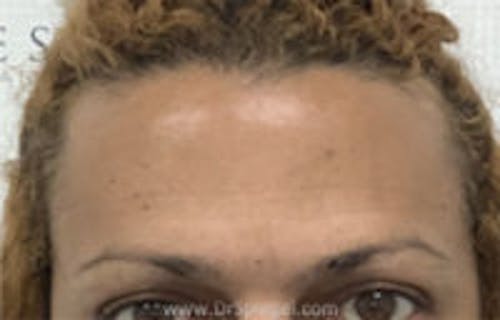 Brow Lift / Fox Eye Lift Before & After Gallery - Patient 308291 - Image 1